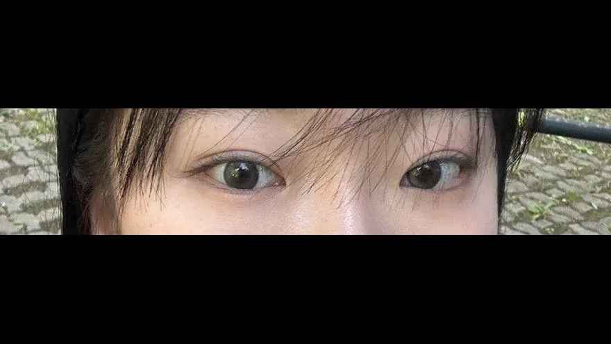 Partial Incision Double Eyelid Surgery, Ptosis Correction, Bulbous Nose, Nasal Tip, Nasal Bridge — RE&RE PLASTIC SURGERY 3
