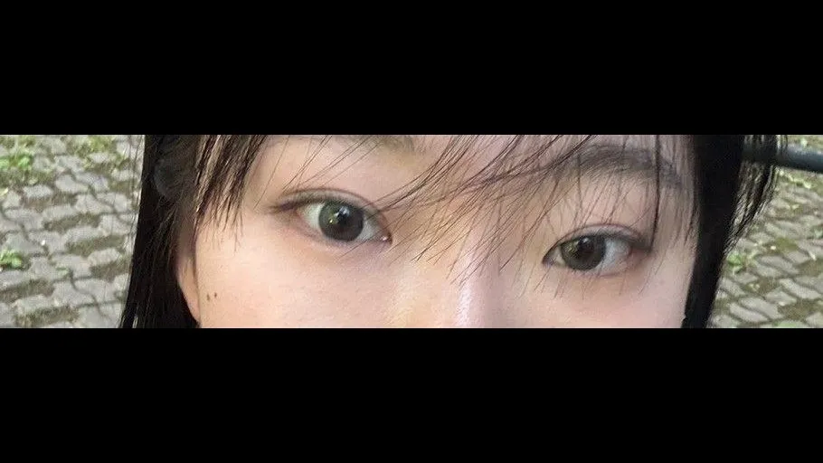 Partial Incision Double Eyelid Surgery, Ptosis Correction, Bulbous Nose, Nasal Tip, Nasal Bridge — RE&RE PLASTIC SURGERY 4