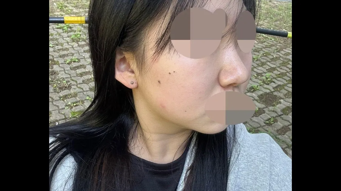 Partial Incision Double Eyelid Surgery, Ptosis Correction, Bulbous Nose, Nasal Tip, Nasal Bridge — RE&RE PLASTIC SURGERY 5