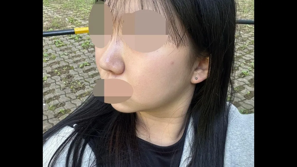 Partial Incision Double Eyelid Surgery, Ptosis Correction, Bulbous Nose, Nasal Tip, Nasal Bridge — RE&RE PLASTIC SURGERY 6