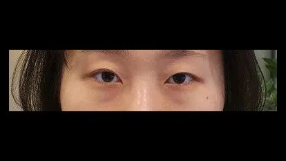 Natural Adhesion Double Eyelid Surgery, Lower Eyelid Fat Repositioning — RE&RE PLASTIC SURGERY 1