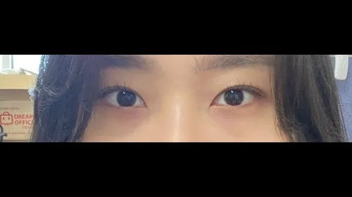 Natural Adhesion Double Eyelid Surgery, Lower Eyelid Fat Repositioning — RE&RE PLASTIC SURGERY 2