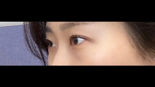 Natural Adhesion Double Eyelid Surgery, Lower Eyelid Fat Repositioning — RE&RE PLASTIC SURGERY 3