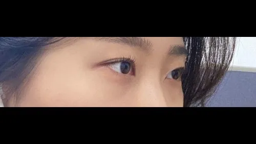 Natural Adhesion Double Eyelid Surgery, Lower Eyelid Fat Repositioning — RE&RE PLASTIC SURGERY 4