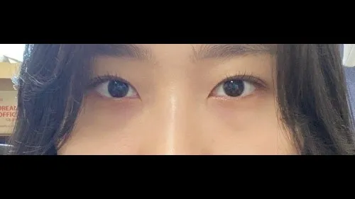 Natural Adhesion Double Eyelid Surgery, Lower Eyelid Fat Repositioning — RE&RE PLASTIC SURGERY 5