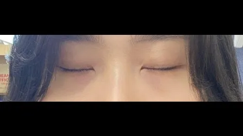 Natural Adhesion Double Eyelid Surgery, Lower Eyelid Fat Repositioning — RE&RE PLASTIC SURGERY 6