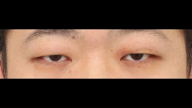 Incisional Double Eyelid Surgery, Ptosis Correction — RE&RE PLASTIC SURGERY 1