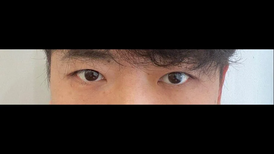 Incisional Double Eyelid Surgery, Ptosis Correction — RE&RE PLASTIC SURGERY 2