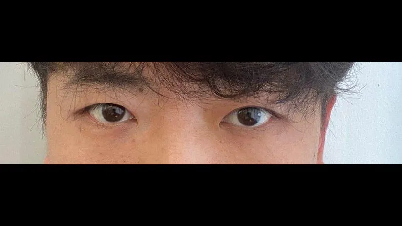 Incisional Double Eyelid Surgery, Ptosis Correction — RE&RE PLASTIC SURGERY 3