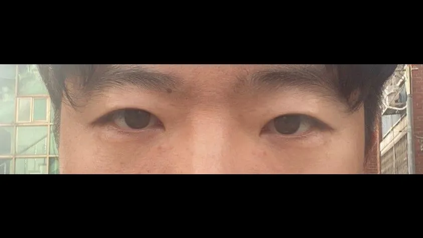 Incisional Double Eyelid Surgery, Ptosis Correction — RE&RE PLASTIC SURGERY 4