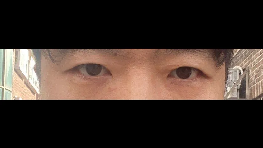 Incisional Double Eyelid Surgery, Ptosis Correction — RE&RE PLASTIC SURGERY 5