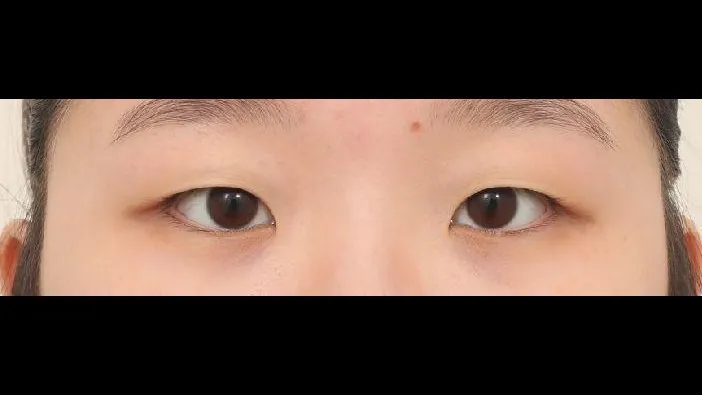 Partial Incision Double Eyelid Surgery, Ptosis Correction — RE&RE PLASTIC SURGERY 1