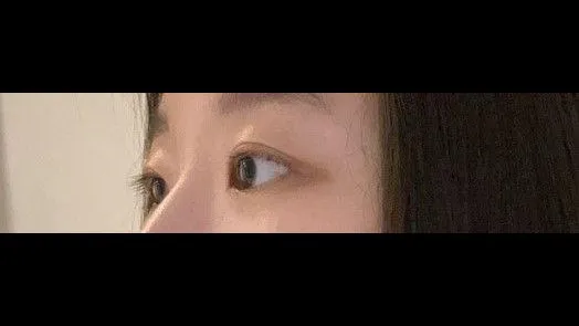 Partial Incision Double Eyelid Surgery, Ptosis Correction — RE&RE PLASTIC SURGERY 2