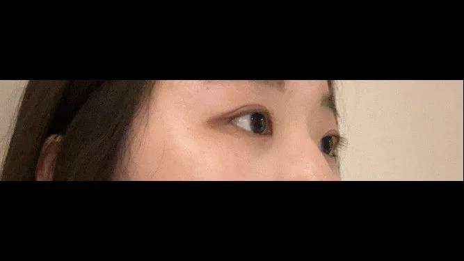 Partial Incision Double Eyelid Surgery, Ptosis Correction — RE&RE PLASTIC SURGERY 3