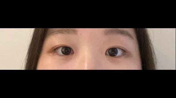 Partial Incision Double Eyelid Surgery, Ptosis Correction — RE&RE PLASTIC SURGERY 4