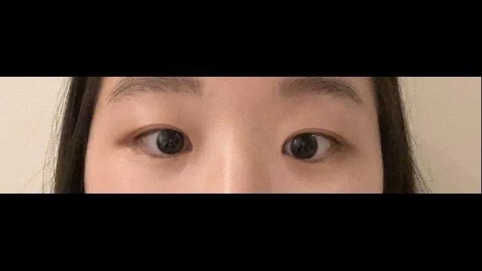 Partial Incision Double Eyelid Surgery, Ptosis Correction — RE&RE PLASTIC SURGERY 5