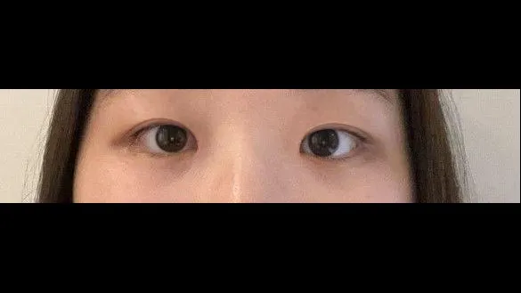 Partial Incision Double Eyelid Surgery, Ptosis Correction — RE&RE PLASTIC SURGERY 6