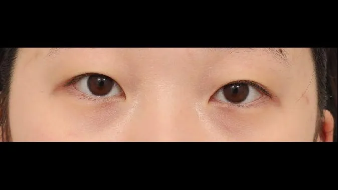 Natural Adhesion Double Eyelid Surgery, Ptosis Correction — RE&RE PLASTIC SURGERY 1