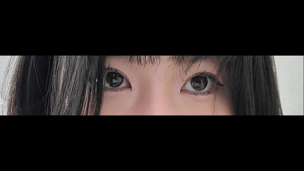 Natural Adhesion Double Eyelid Surgery, Ptosis Correction — RE&RE PLASTIC SURGERY 2