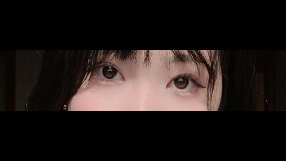 Natural Adhesion Double Eyelid Surgery, Ptosis Correction — RE&RE PLASTIC SURGERY 4