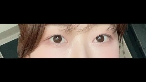 Natural Adhesion Double Eyelid Surgery, Lower Eyelid Fat Repositioning, Lower Eyelid Fat Grafting — RE&RE PLASTIC SURGERY 2