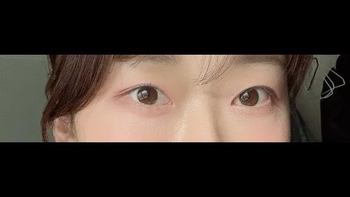 Natural Adhesion Double Eyelid Surgery, Lower Eyelid Fat Repositioning, Lower Eyelid Fat Grafting — RE&RE PLASTIC SURGERY 3