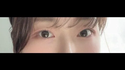 Natural Adhesion Double Eyelid Surgery, Lower Eyelid Fat Repositioning, Lower Eyelid Fat Grafting — RE&RE PLASTIC SURGERY 4