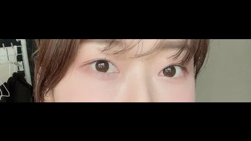 Natural Adhesion Double Eyelid Surgery, Lower Eyelid Fat Repositioning, Lower Eyelid Fat Grafting — RE&RE PLASTIC SURGERY 5