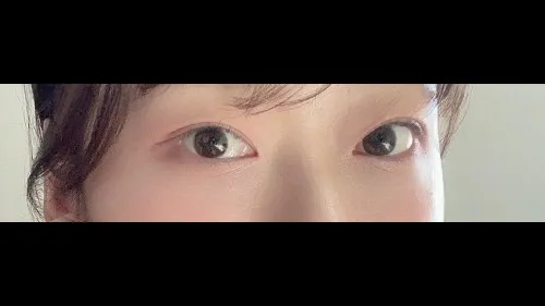 Natural Adhesion Double Eyelid Surgery, Lower Eyelid Fat Repositioning, Lower Eyelid Fat Grafting — RE&RE PLASTIC SURGERY 6