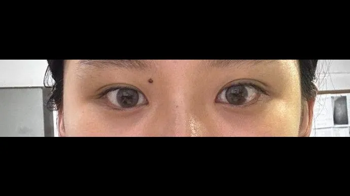 Natural Adhesion Double Eyelid Surgery, Ptosis Correction — RE&RE PLASTIC SURGERY 2