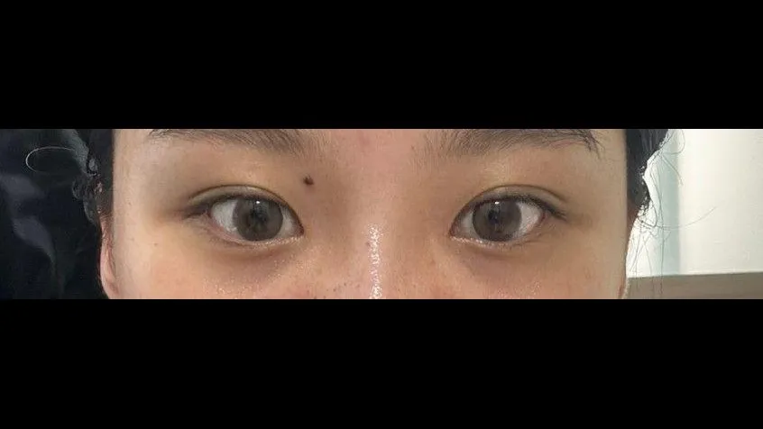 Natural Adhesion Double Eyelid Surgery, Ptosis Correction — RE&RE PLASTIC SURGERY 3