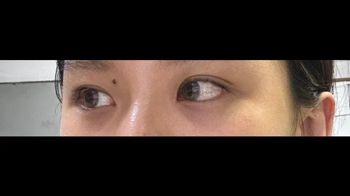 Natural Adhesion Double Eyelid Surgery, Ptosis Correction — RE&RE PLASTIC SURGERY 4