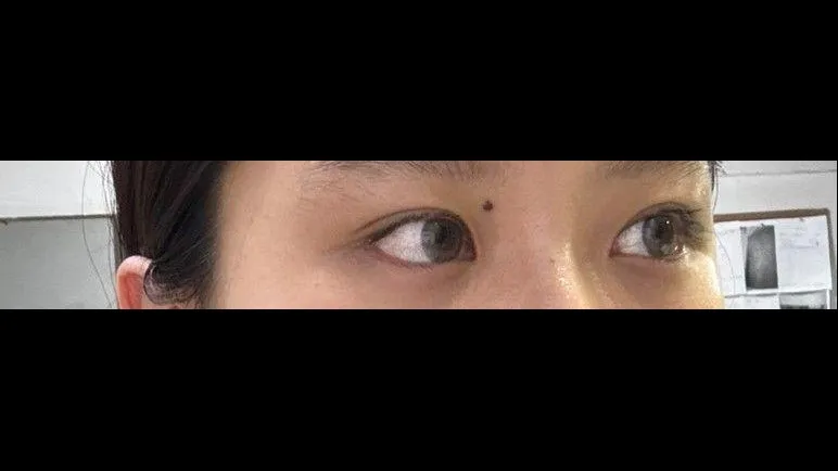 Natural Adhesion Double Eyelid Surgery, Ptosis Correction — RE&RE PLASTIC SURGERY 5
