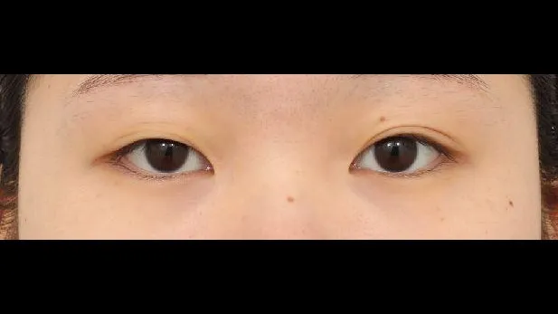 目つき矯正, 自然癒着法, 目つき矯正再手術 1