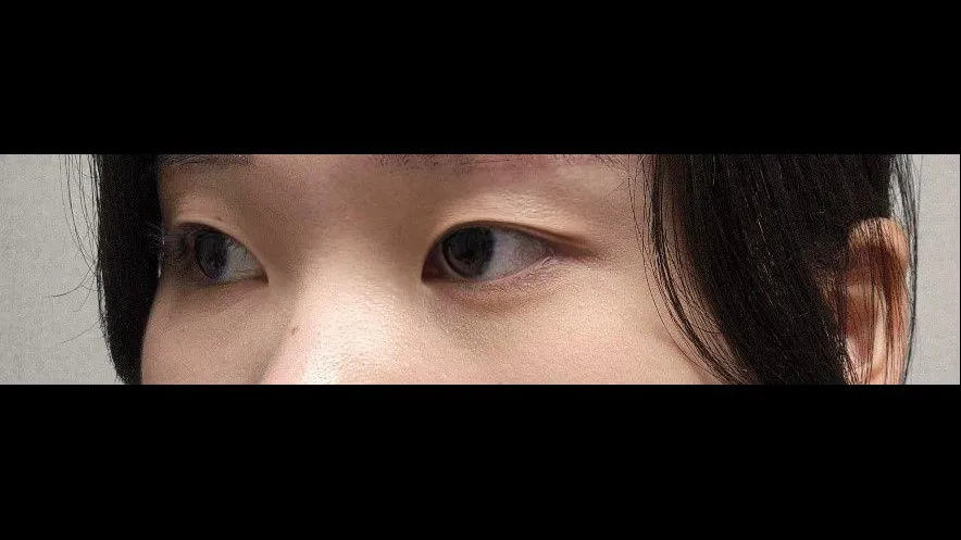 目つき矯正, 自然癒着法, 目つき矯正再手術 2
