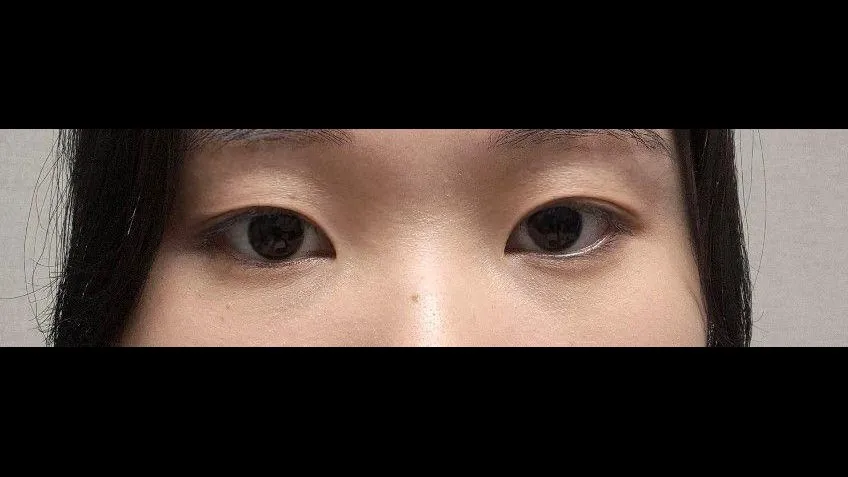 Ptosis Correction, Natural Adhesion Double Eyelid Surgery, Revision ptosis correction — RE&RE PLASTIC SURGERY 3