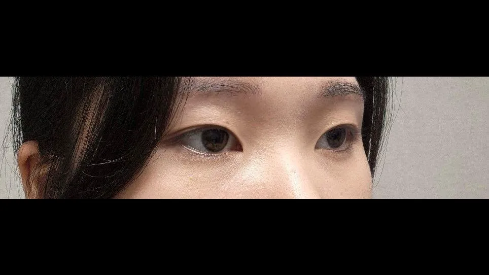 Ptosis Correction, Natural Adhesion Double Eyelid Surgery, Revision ptosis correction — RE&RE PLASTIC SURGERY 4