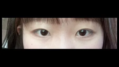 Natural Adhesion Double Eyelid Surgery, Ptosis Correction — RE&RE PLASTIC SURGERY 2