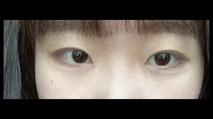 Natural Adhesion Double Eyelid Surgery, Ptosis Correction — RE&RE PLASTIC SURGERY 3