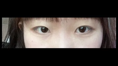 Natural Adhesion Double Eyelid Surgery, Ptosis Correction — RE&RE PLASTIC SURGERY 4