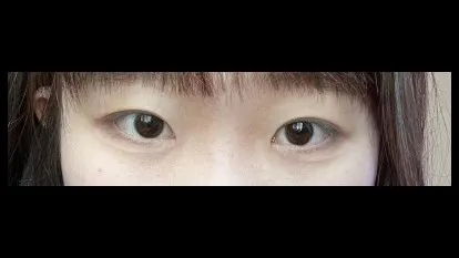 Natural Adhesion Double Eyelid Surgery, Ptosis Correction — RE&RE PLASTIC SURGERY 5