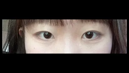 Natural Adhesion Double Eyelid Surgery, Ptosis Correction — RE&RE PLASTIC SURGERY 6
