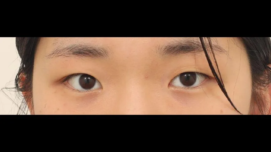 Natural Adhesion Double Eyelid Surgery — RE&RE PLASTIC SURGERY 1