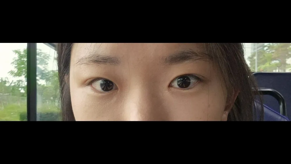 Natural Adhesion Double Eyelid Surgery — RE&RE PLASTIC SURGERY 2