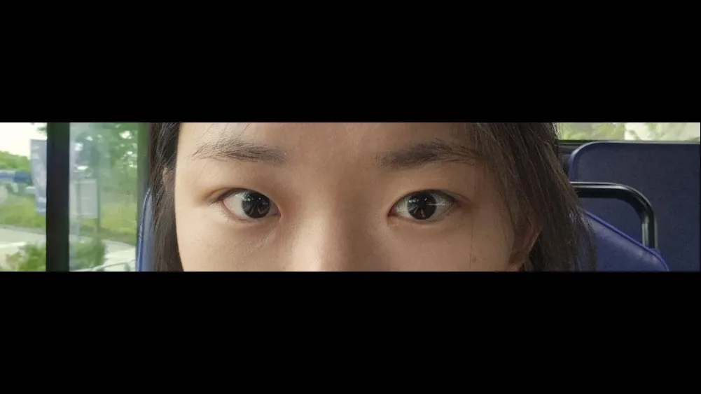 Natural Adhesion Double Eyelid Surgery — RE&RE PLASTIC SURGERY 3