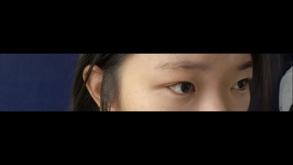 Natural Adhesion Double Eyelid Surgery — RE&RE PLASTIC SURGERY 4
