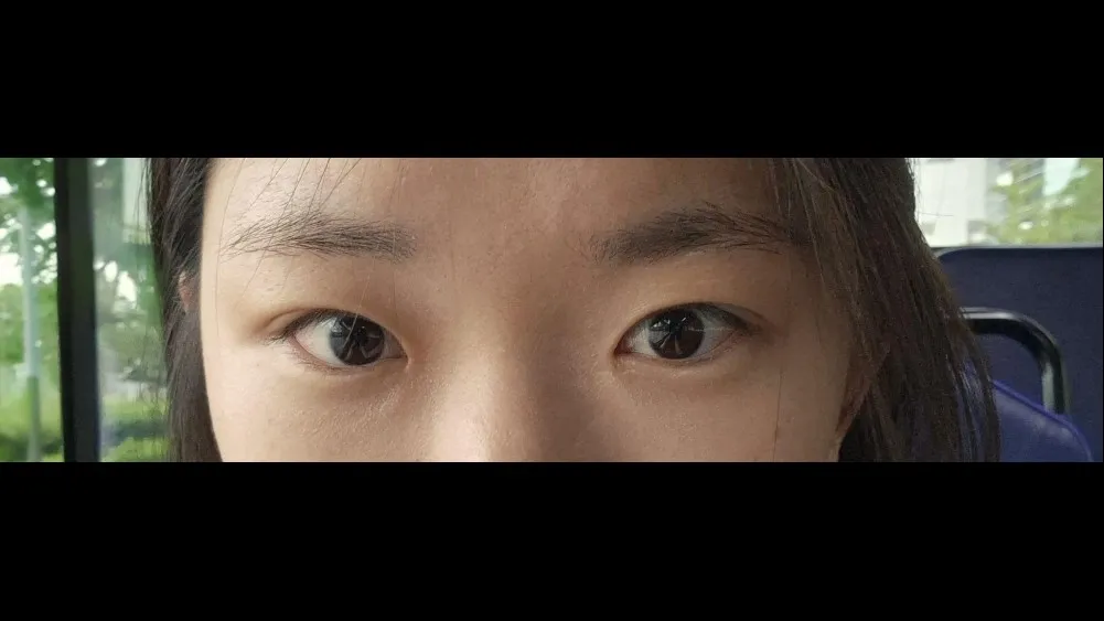 Natural Adhesion Double Eyelid Surgery — RE&RE PLASTIC SURGERY 5