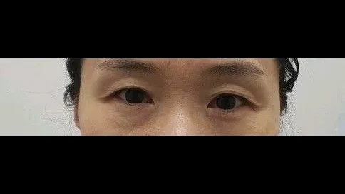部分切開二重術, 目つき矯正, 目つき矯正再手術 — RE&RE PLASTIC SURGERY 1