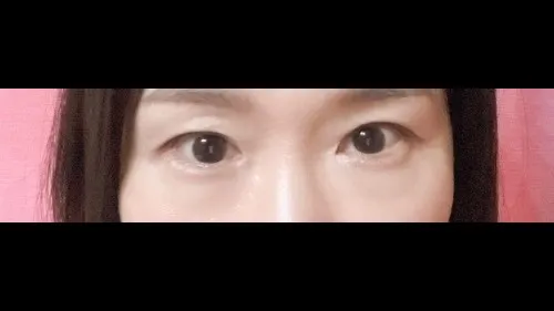 部分切開二重術, 目つき矯正, 目つき矯正再手術 — RE&RE PLASTIC SURGERY 2