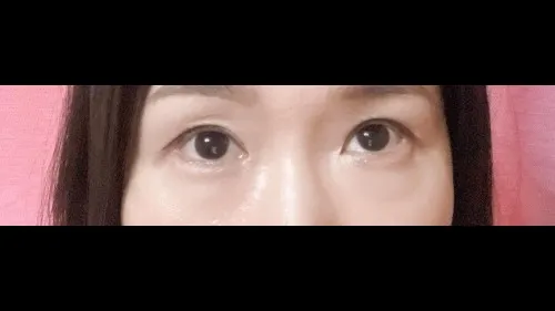 部分切開二重術, 目つき矯正, 目つき矯正再手術 — RE&RE PLASTIC SURGERY 3